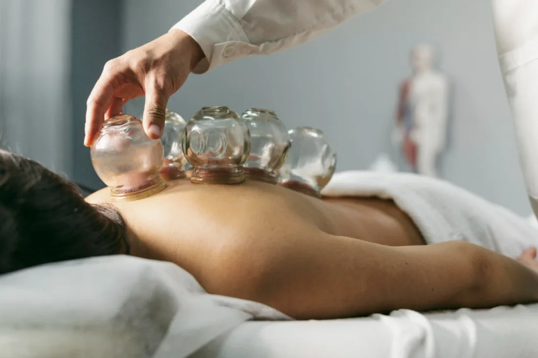 Cupping Massage at Emerald Spa & Bistro in Sherwood Park